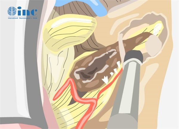 聽神經(jīng)瘤手術(shù)開顱是大手術(shù)嗎