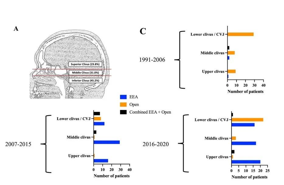 單鼻孔內(nèi)鏡下全切斜坡脊索瘤——手術(shù)入路