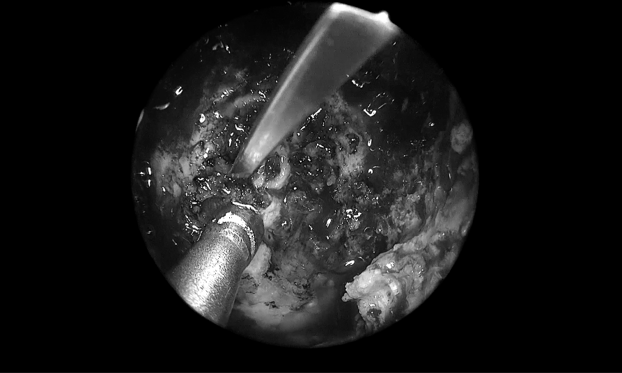 單鼻孔進(jìn)入，粘膜切開(kāi)