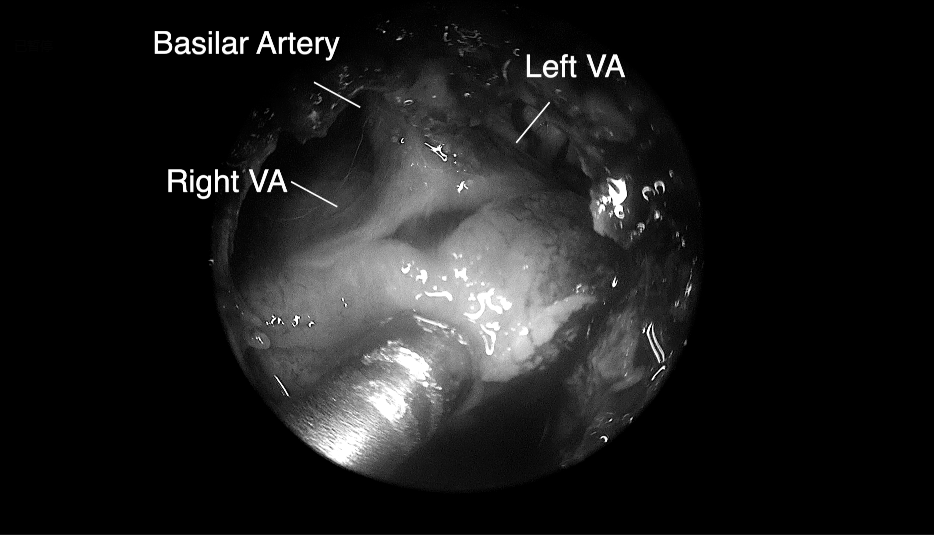 將腫瘤分離出來(lái)——Basilar Artery，基底動(dòng)脈;Left VA，左側(cè)椎動(dòng)脈; Right VA，右側(cè)椎動(dòng)脈;