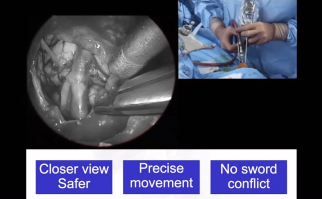 福教授經(jīng)鼻內(nèi)鏡手術(shù)中“筷子技術(shù)”的應(yīng)用