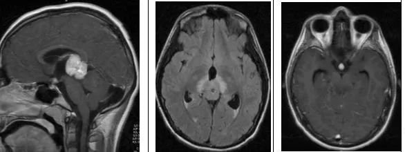 松果體區(qū)腫瘤——影像