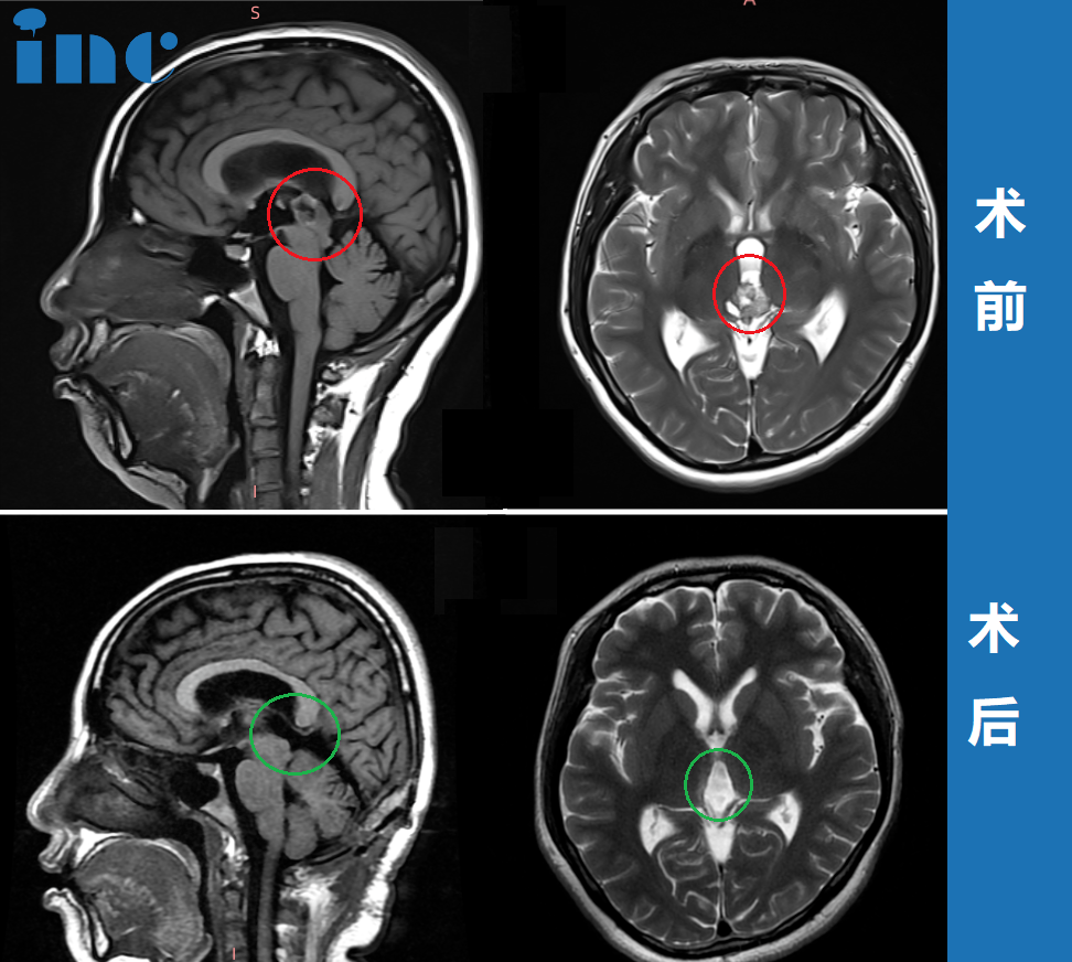 36歲女性-松果體區(qū)腫瘤