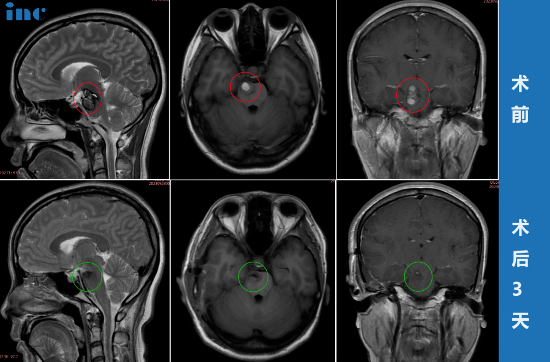 30歲女性-腦干海綿狀血管瘤