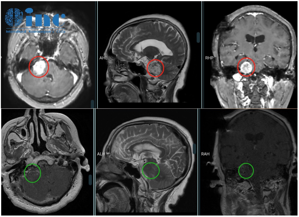 聽神經(jīng)瘤案例——術(shù)前術(shù)后影像