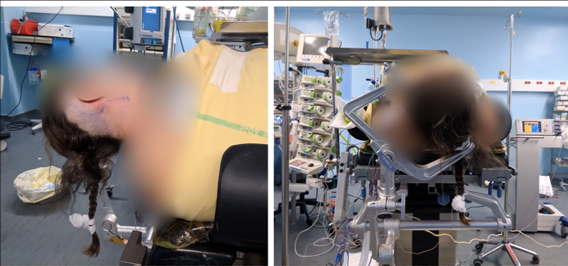 手術(shù)體位：仰臥位