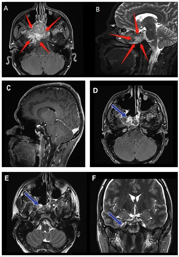 33歲男士斜坡脊索瘤不愿開(kāi)顱，福教授鼻內(nèi)鏡下入路全切腫瘤