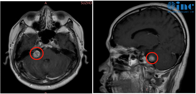 聽神經(jīng)瘤真實案例