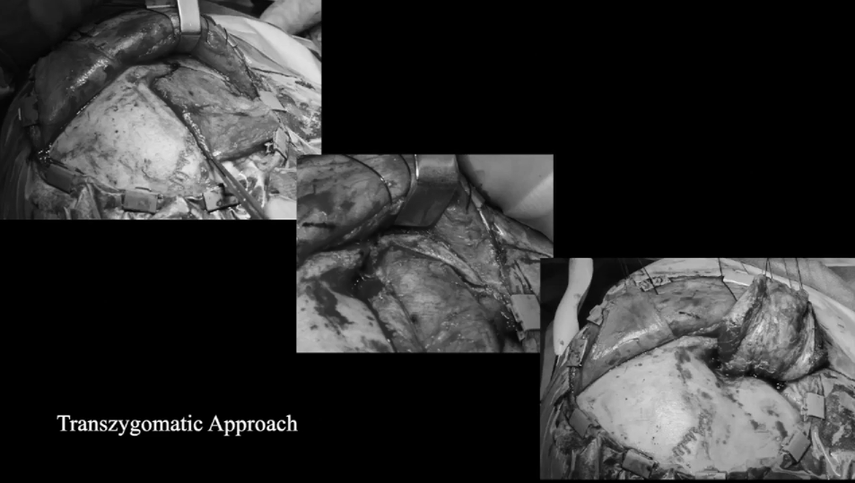 使用顴弓入路手術(shù)，利用筷子技術(shù)神經(jīng)內(nèi)鏡+顯微鏡次全切除腫瘤，從海綿竇剝離硬腦膜，切除了浸潤的硬腦膜和向顳部延伸的硬膜上腦膜瘤。