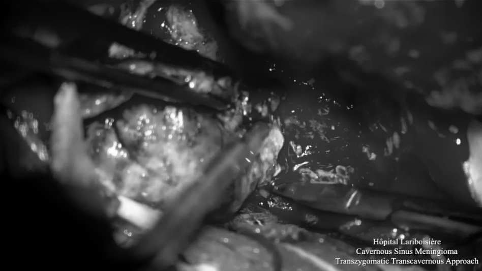 顯微鏡下切除部分腫瘤或瘤內(nèi)減壓