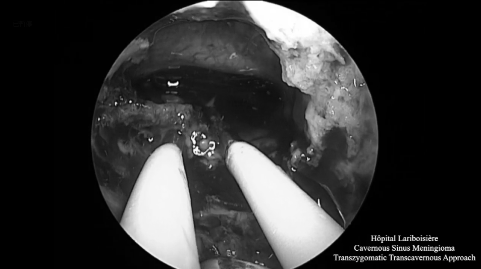 神經(jīng)內(nèi)鏡下切除腫瘤后的術(shù)野