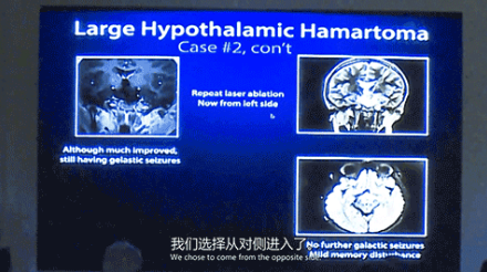 新興微創(chuàng)激光技術(shù)LITT的合適性