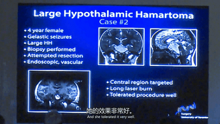 新興微創(chuàng)激光技術(shù)LITT的合適性