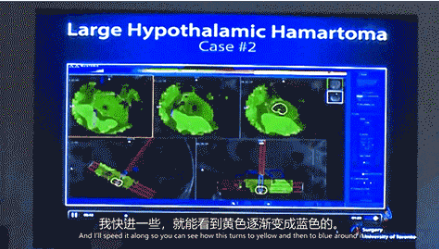 新興微創(chuàng)激光技術(shù)LITT的合適性