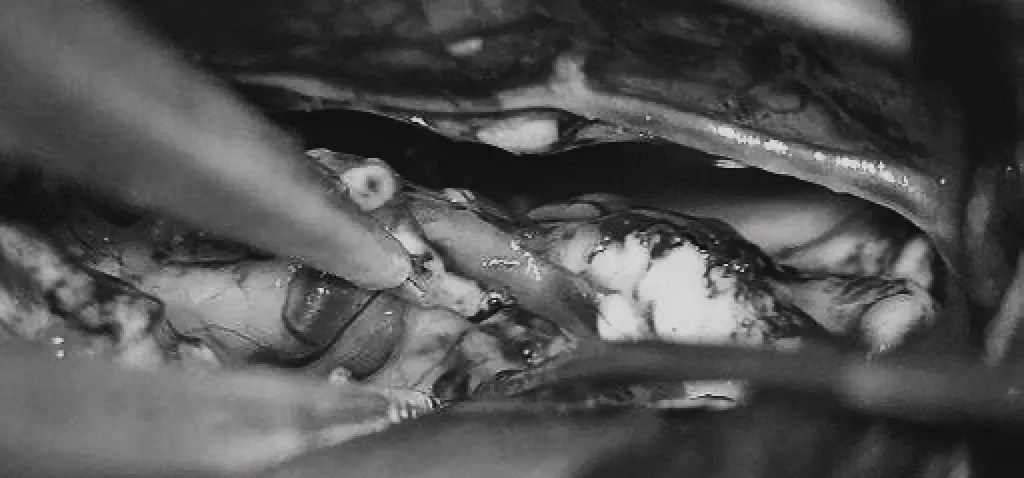 （c）雙額開顱，打開縱裂（鼻朝右，中線水平位，重力牽拉右側(cè)半球），顯露胼胝體、CmaA和PcaA。(d)切開胼胝體2.5cm，顯露透明隔內(nèi)的AVM，大致顯露ACA。