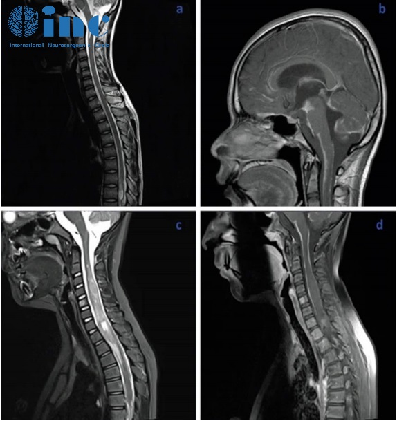 ?8歲男孩罹患少見腦瘤