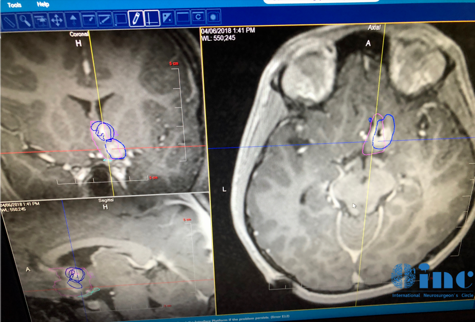 術(shù)后情況：LITT手術(shù)后Jason很快便出院了，之后他便沒有癲癇發(fā)作了，而且近期隨訪顯示其生長發(fā)育和智力發(fā)育正常，而且癲癇并未復(fù)發(fā)。