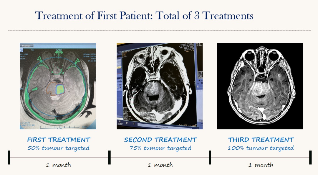 一例患者的治療:3次磁波刀治療