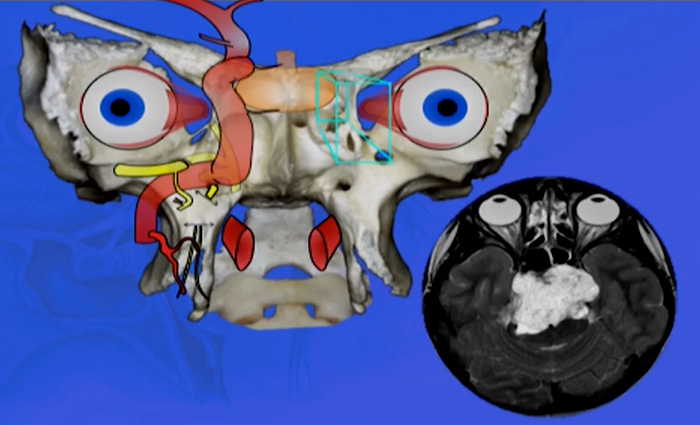 顱底及顱頸交界脊索瘤