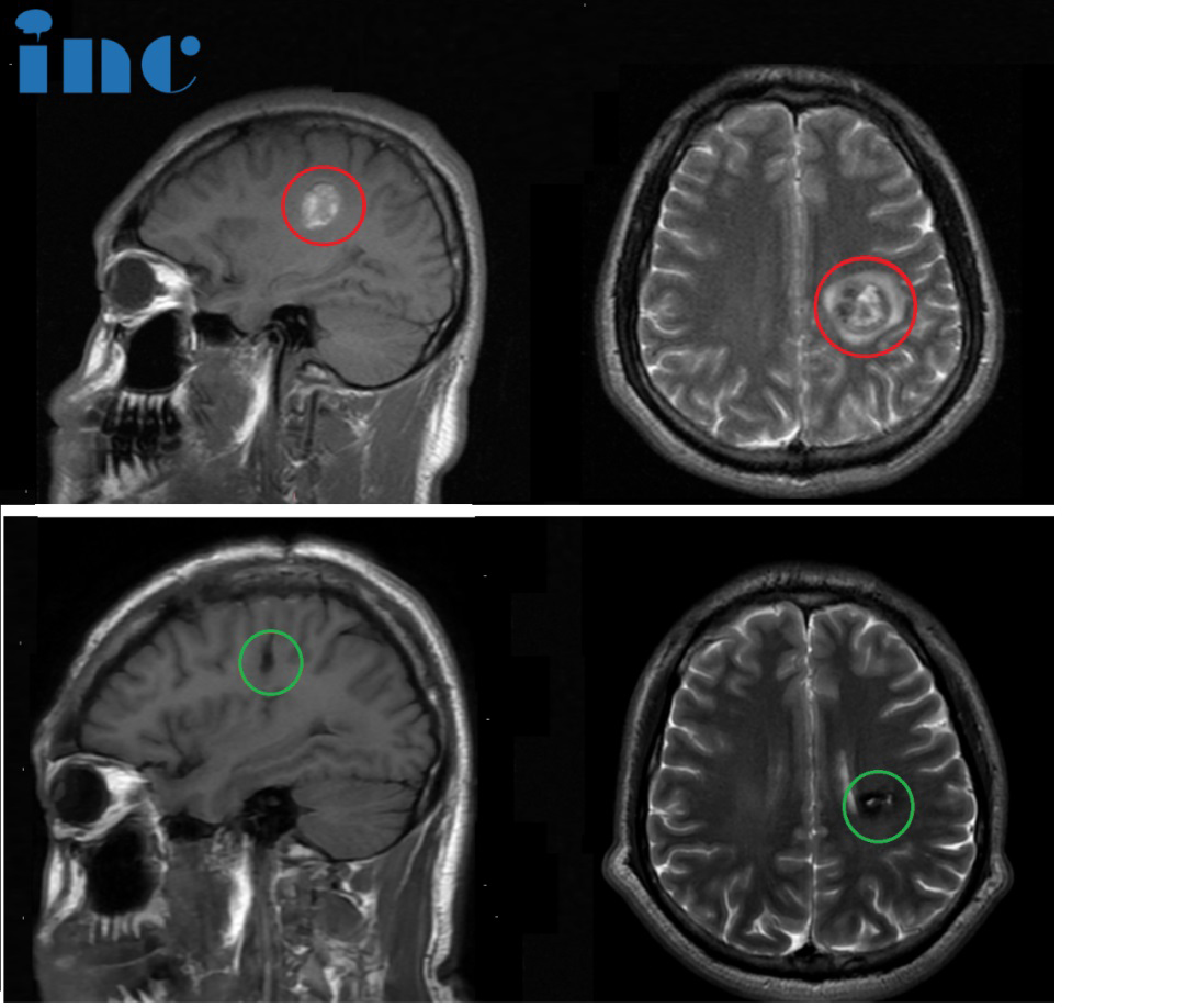功能區(qū)海綿狀血管瘤案例：在腦功能區(qū)上手術(shù)有多難？國際神外教授準確定位、順利鏟除“不定時炸彈”