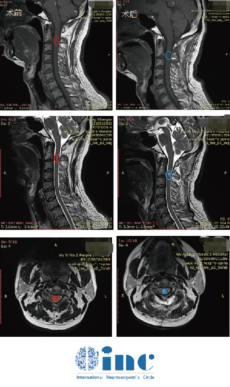 劉先生的術(shù)前術(shù)后MRI對(duì)比