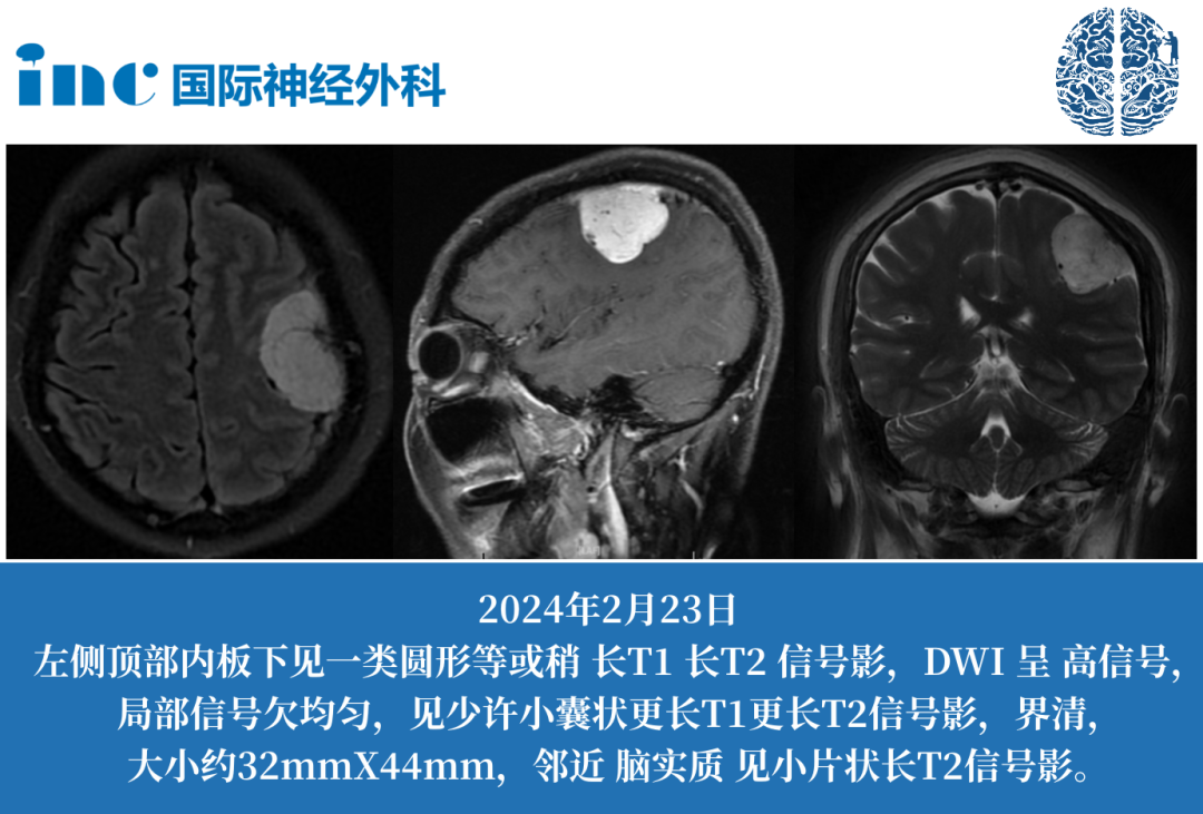 51歲女性-額葉腦膜瘤  　　如果巴教授做手術(shù)，能否全切？