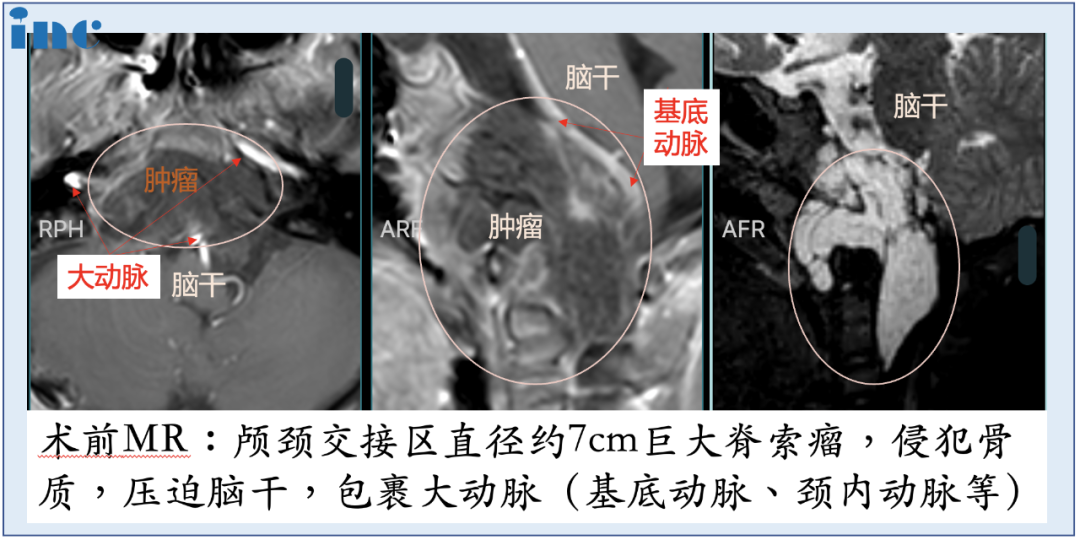 低體重幼齡兒童較大脊索瘤案例圖片