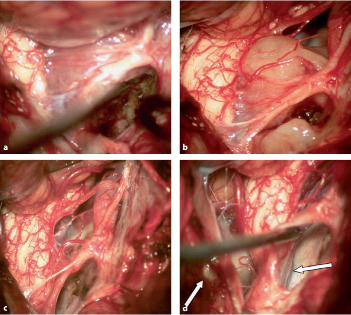 圖13.14腫瘤的術(shù)中照片如圖13.13所示。a:首先，分離腫瘤和周邊血管及腦組織，阻斷腫瘤血供。這種斷流術(shù)是在對(duì)側(cè)顱尾側(cè)進(jìn)行，直到整個(gè)腫瘤與血管供應(yīng)分離。b:剩下的無(wú)血管腫瘤部分現(xiàn)在可以從顱神經(jīng)的根上輕輕地分開，并分塊切除腫瘤。c:腫瘤完全切除后，見(jiàn)顱神經(jīng)扭曲，椎動(dòng)脈近端V4部分和顱神經(jīng)未見(jiàn)腫瘤。d:C1水平是上頸髓受壓較大的部位，腫瘤壓迫神經(jīng)壓迫寰樞椎弓。