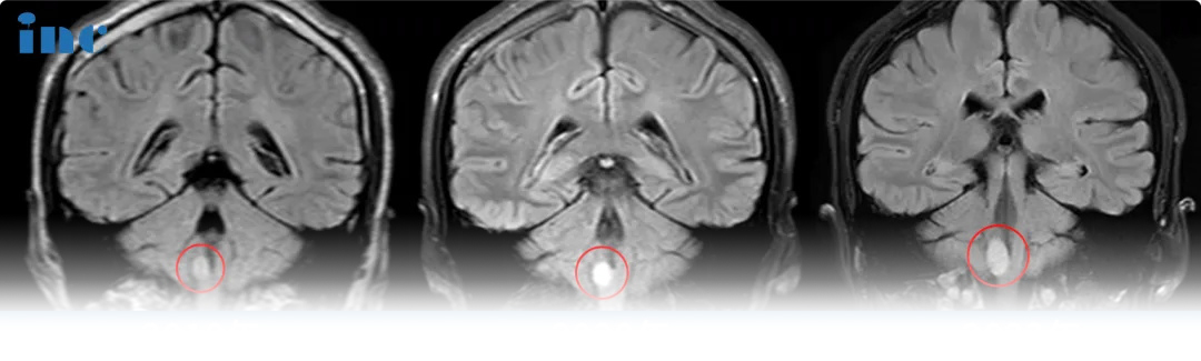 腦干延髓膠質(zhì)瘤真實案例影像圖片