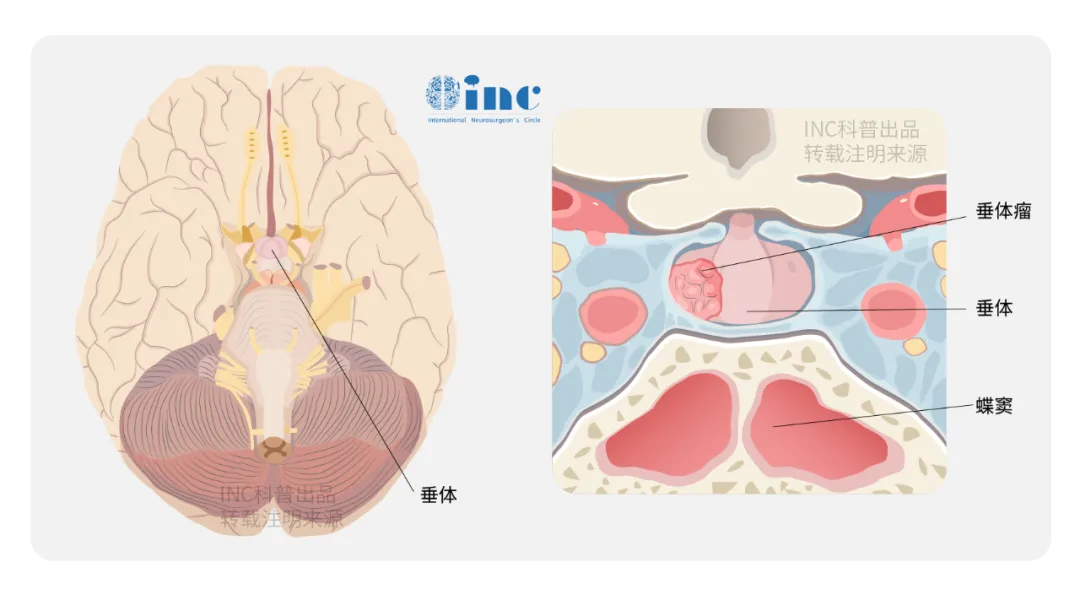 侵襲性垂體瘤圖片
