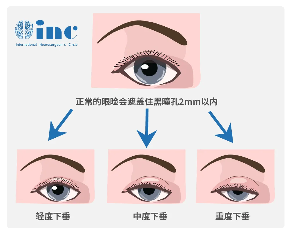 侵襲性垂體瘤實例交流