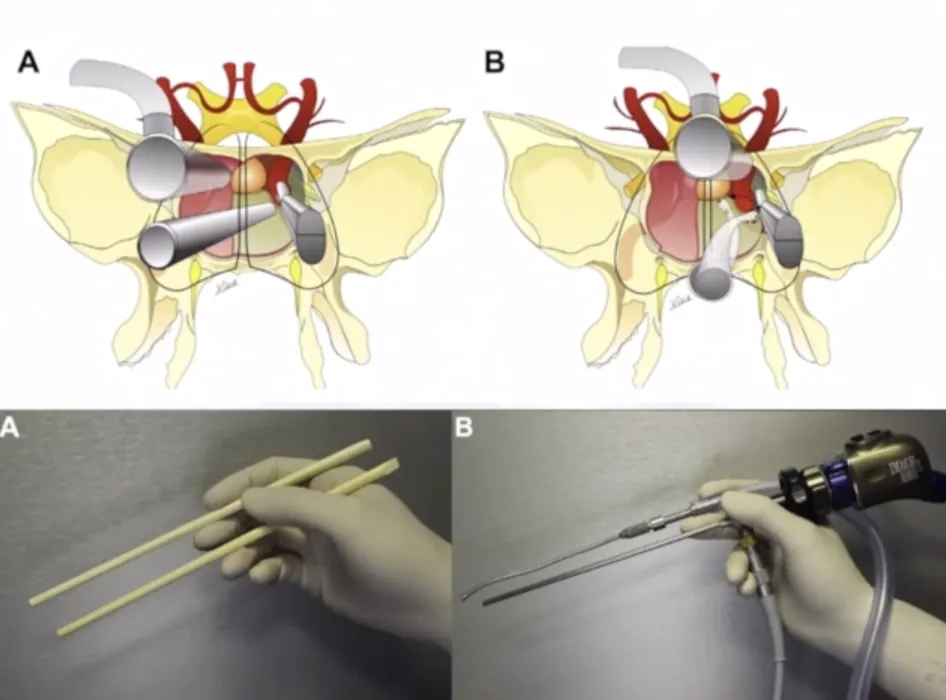 侵襲性垂體瘤可以用內(nèi)鏡治療嗎？