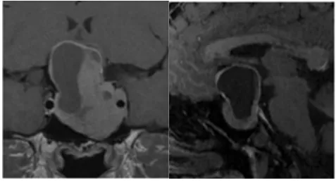 侵襲性垂體瘤實例交流——病灶圖片