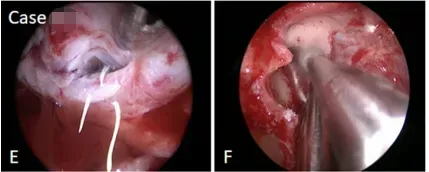 較大垂體瘤耐藥又術(shù)后復(fù)發(fā)圖片