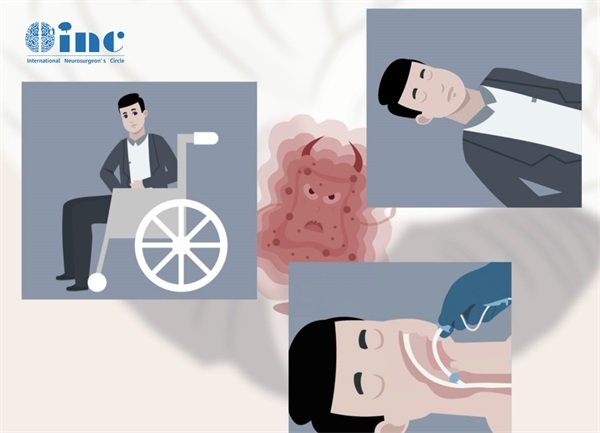 聽神經(jīng)瘤后遺癥有哪些?