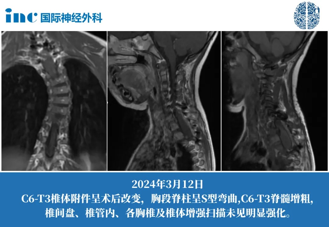 4歲女孩--脊髓節(jié)細(xì)胞膠質(zhì)瘤案例圖片