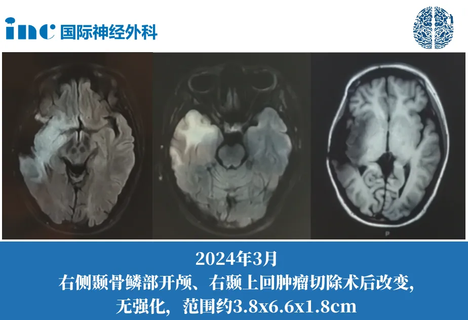 島葉、顳葉、額葉較大膠質瘤手術是首要選擇