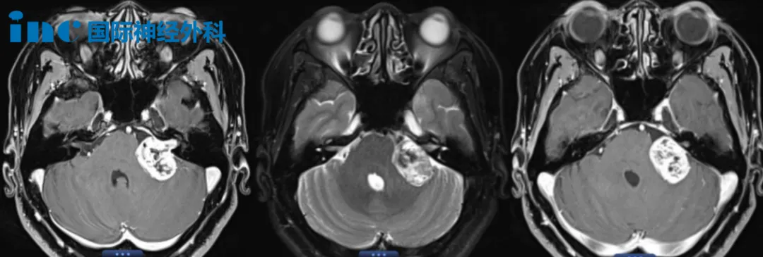 52歲女性-左側(cè)較大聽神經(jīng)瘤案例圖片