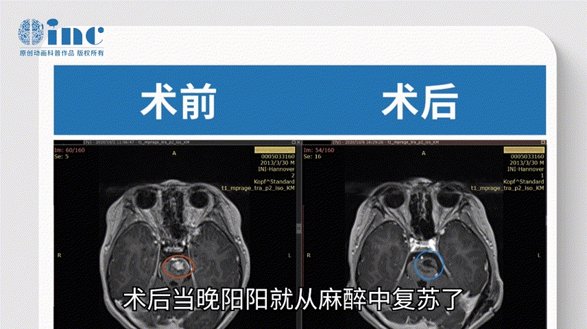 巴特朗菲教授——腦海綿狀血管瘤案例