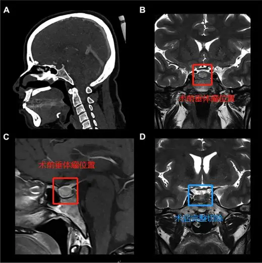 37歲女性-蝶鞍中心垂體瘤