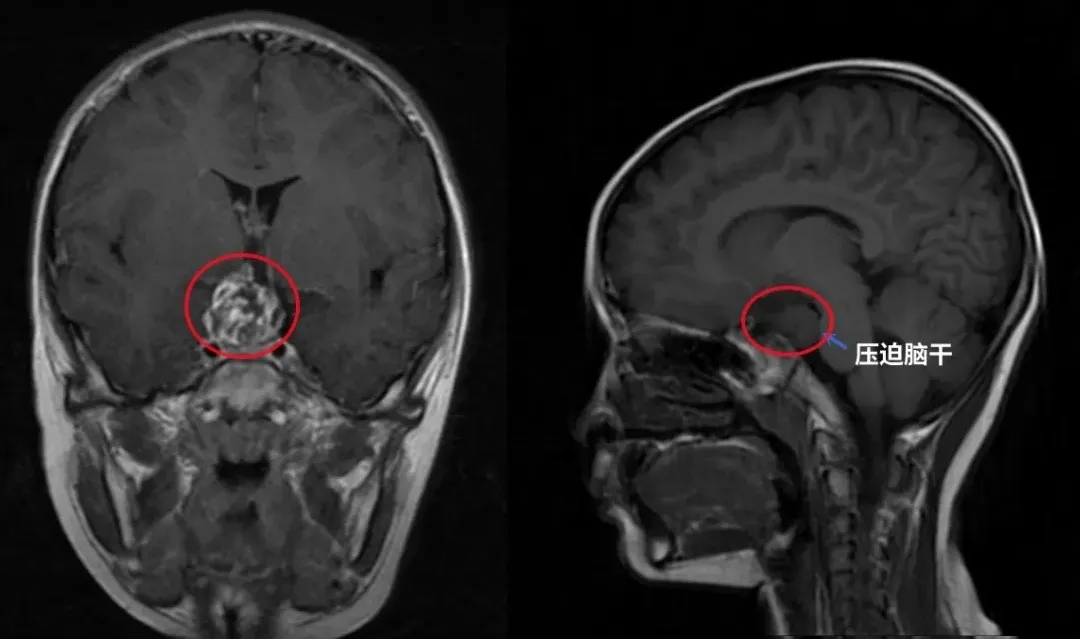 鞍區(qū)腫瘤，顱咽管瘤，和周圍大血管動(dòng)脈關(guān)系緊密