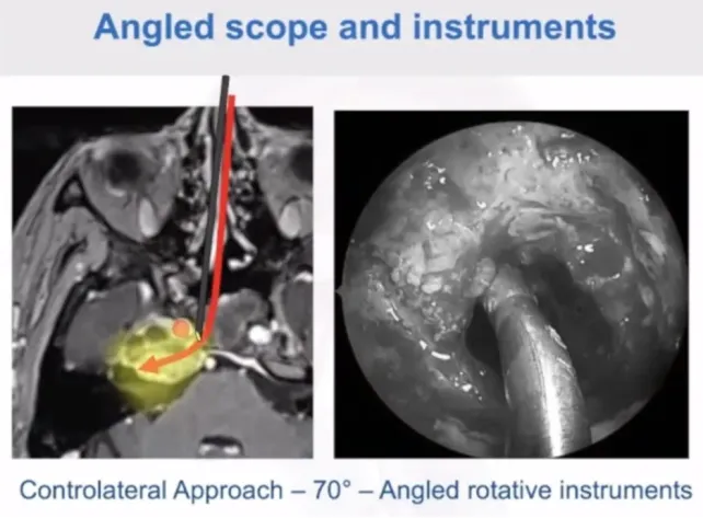 下圖可以看到這是一個(gè)70度鏡，這個(gè)角度可以進(jìn)入很深的位置，可以在梅克爾腔下面去吸除腫瘤，從這個(gè)位置可以向外側(cè)去，這是一個(gè)很好的選擇。