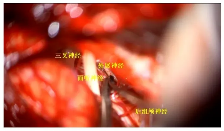三叉神經(jīng)、面聽神經(jīng)、外展神經(jīng)、后組神經(jīng)保護完好