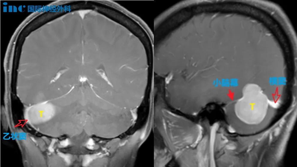腫瘤位置與乙狀竇、橫竇關(guān)系密切