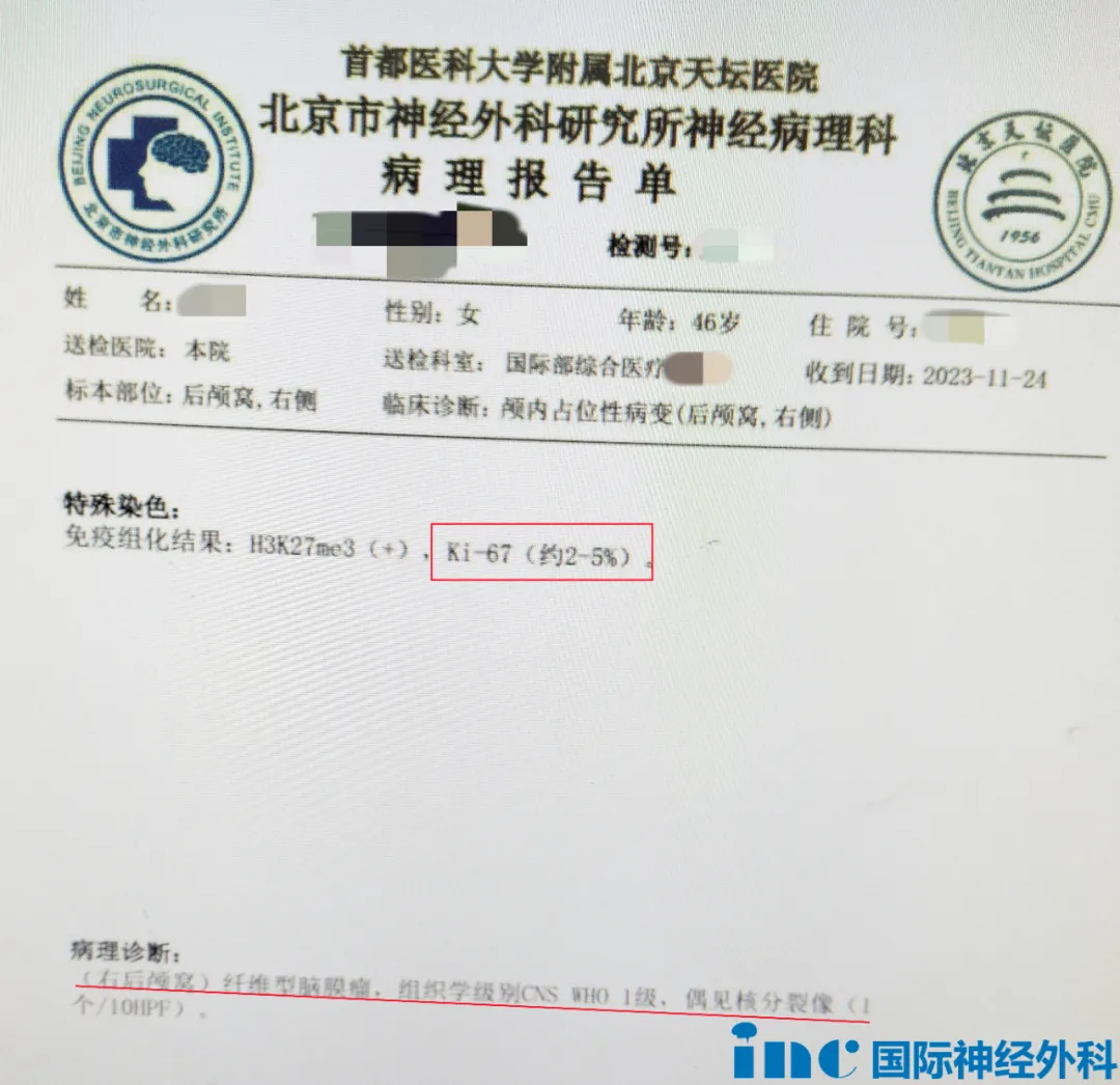 術(shù)后病理報(bào)告為1級(jí)纖維型腦膜瘤，預(yù)后良好