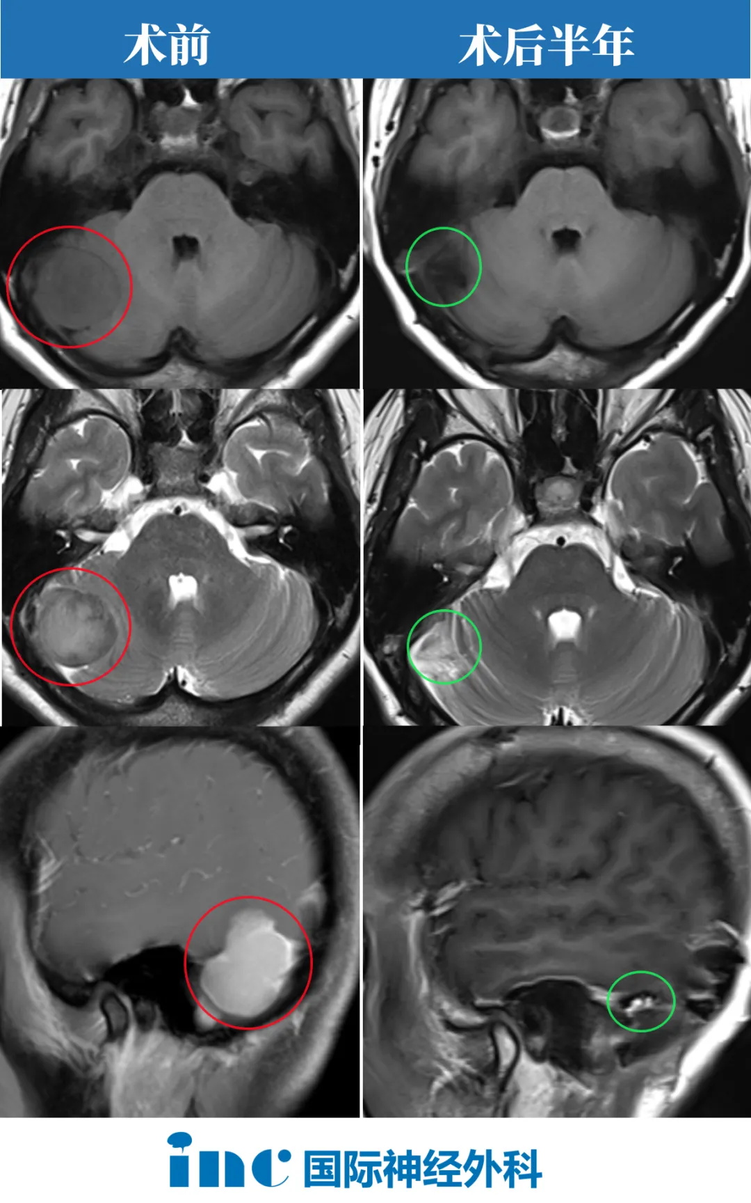 術(shù)后半年隨訪時(shí)，巴教授在查看了孫女士影像后回復(fù)