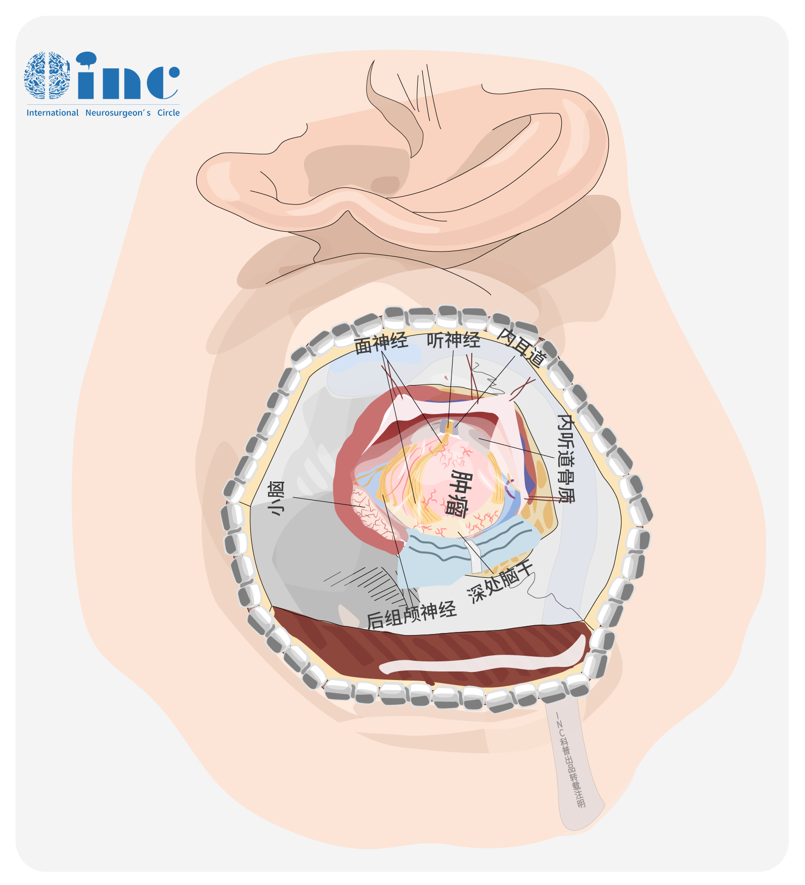 乙狀竇后入路切除聽神經瘤圖片