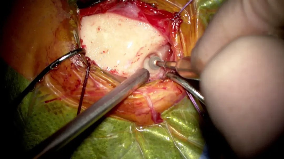 用磨鉆“打孔”