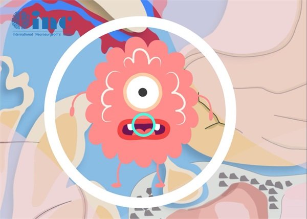 聽神經瘤是切還是不切比較好?切除后還有聽力嗎?