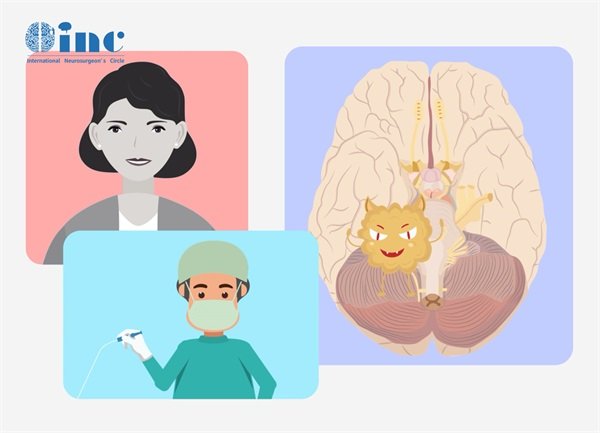 腦橋占位中線性膠質(zhì)瘤手術(shù)能全切嗎?能做到不復(fù)發(fā)嗎?